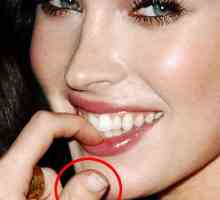 Brachydactyly, sau cu degetul mare al lui Megan Fox