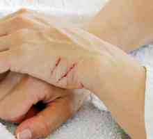 Zgârieturi pe mâini: cauze, tratament, preparate. Cream `Rescuer`: instrucțiuni de…