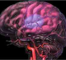 Ischemie cerebrală de gradul 2 la nou-născuți: simptome și tratament. Ischemie cerebrală de gradul…