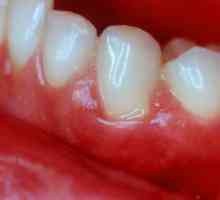 Care este tratamentul pentru boala gingiilor? Sfaturi utile