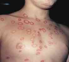 Care este diferența dintre microsporia pielii netede?