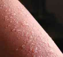 Ce cauzează erupțiile pe piele sub formă de bule?