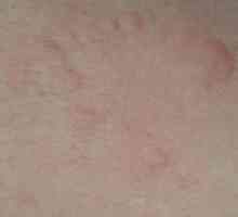 Crawling acnee pe corp: cauze posibile