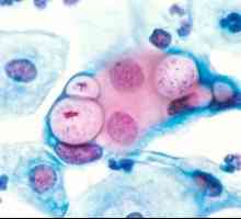 Chlamydia trachomatis. Ce este și ce provoacă bolile?