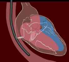 Transmitere ecocardiografică transesofagiană: ce este?