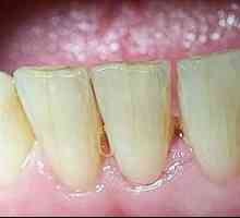 Ce se întâmplă dacă există fisuri în dinți? Cauze și tratament