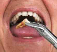 Ce se poate face după extracția dinților - modalități de a opri sângele și de a vindeca rana