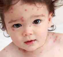 Ce să faci cu varicela? Simptomele și tratamentul bolii