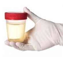 Ce arată analiza urinei pentru Nechiporenko? Pentru a descifra analiza de urină de către…