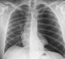 Ce arată radiografia? Interpretarea competentă a radiografiei plămânilor