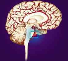 Ce este un anevrism al vaselor cerebrale? Anevrismul creierului: simptome, diagnostic