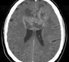 Ce este astrocitomul creierului? Astrocitomul creierului: prognostic