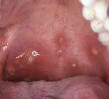 Ce este herpesul în gât la copii? Dar pentru a trata o infecție?