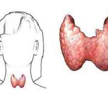 Ce este hipertiroidismul? Simptomele la femei, cauze, manifestări și tratament