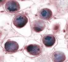 Ce este pneumonia cu chlamydia? Cauzele, simptomele și tratamentul SARS