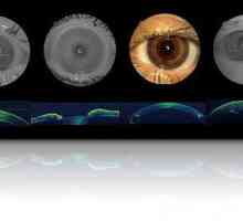 Ce este tomografia optică de coerență a ochiului?