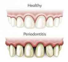 Ce este parodontita? Clasificarea și tratamentul