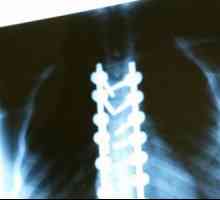 Care este radiografia coloanei vertebrale?