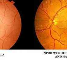Ce este retinopatia la pacienții diabetici? Retinopatia la diabet zaharat: simptome, tratament cu…