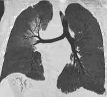 Ce este sarcomul pulmonar? Pot să scap de asta?