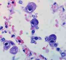 Infecția cu cytomegalovirus la copii: simptome, efecte și caracteristici de tratament