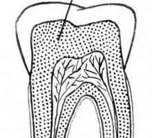 Dentin - ce este asta? Tipurile, structura, compoziția și caracteristicile tratamentului