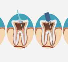 Depopularea dentară: trăsăturile procedurii, indicații