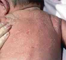 Dermatită exfoliativă la adulți și nou-născuți (fotografie)