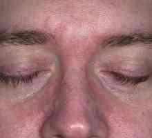 Dermatita pe față - o patologie neplăcută și periculoasă