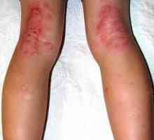 Dermatita pe picioare: cauze și tratament