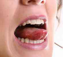 Abaterea limbii în accident vascular cerebral