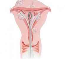 Diagnosticarea chiuretajului uterului: esența operației și indicarea conducerii