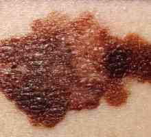 Diagnosticul melanomului cutanat: metode, recenzii