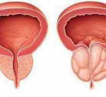 Diagnosticul prostatitei la bărbați - ce trebuie să știți?