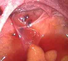 Diathermocoagularea colului uterin: esența și consecințele metodei