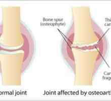 Dieta pentru artroza articulațiilor genunchiului: recomandări