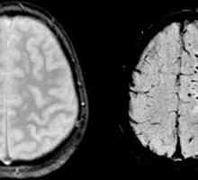 Difuze daune cerebrale axonale: simptome, semne și diagnostice