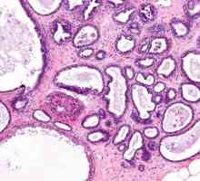 Fibro-adenomatoza difuză a glandelor mamare: cauze și tratament