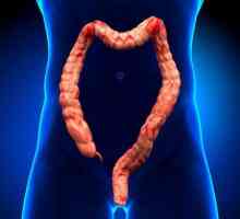 Obstrucție intestinală dinamică: clasificare, cauze, simptome și tratament