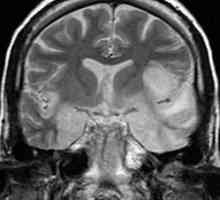 Disfunctia encefalopatiei de gradul III: cat pot trai? Encefalopatia encefalică: semne, simptome,…