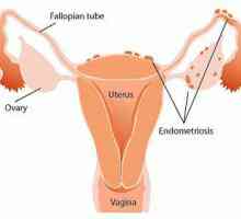 Dyufaston în endometrioză - recenzii. Eficacitatea "Dyufaston", prețul