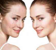 Gauri pe piele: cauze și tratament. Cum să scapi de post-acnee