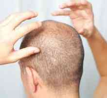 Foliculita scalpului: cauze, simptome, tratament