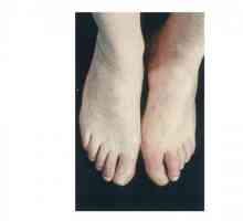 Picioarele gangrene: cauze, simptome și tratament