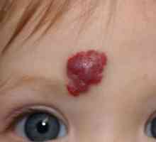 Hemangiomul feței: cauze și tratament. Hemangiomul pe față la adulți și copii