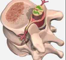 Hemangiomul coloanei vertebrale - ce este? Cum se trateaza un hemangiom al coloanei vertebrale