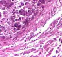 Carcinom hepatocelular al ficatului: diagnostic, simptome și tratament