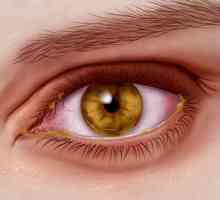 Herpesul pe ochi: tratament, cauze, medicamente