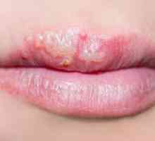 Herpesul pe buze: cum să vindeciți pentru totdeauna remedii folclorice? Este posibil să se vindece…