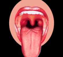 Herpes în limba. Cauzele și tratamentul bolii